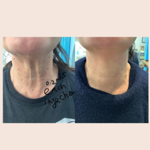 profile before and after neck