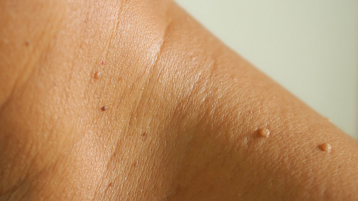 Effective Wart and Skin Tag Removal: What You Need to Know