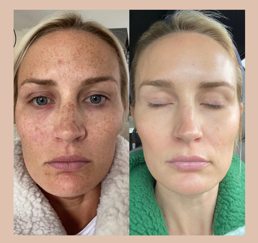 No.23 Skin Kensignton - Pigmentation Treatment