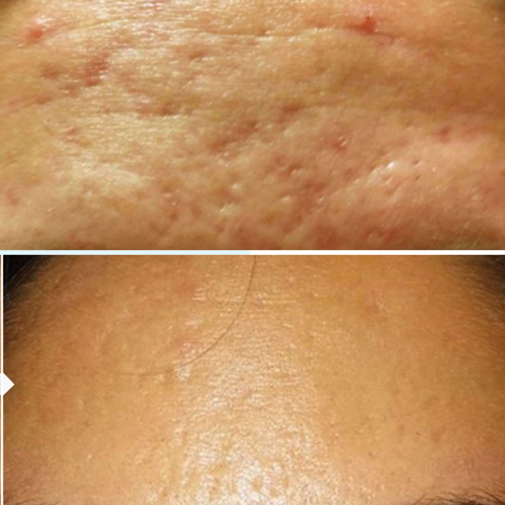 No.23 Skin - The Benefits of Microneedling for Acne