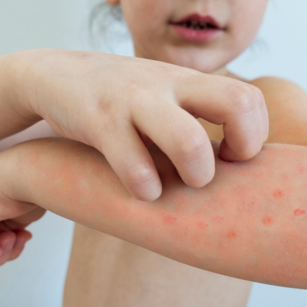 No.23 Skin - Best Ways to help Chickenpox