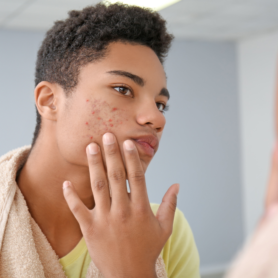 Teen Skincare Acne Guide Dermatologist Teen Skincare Acne Guide Dermatologist