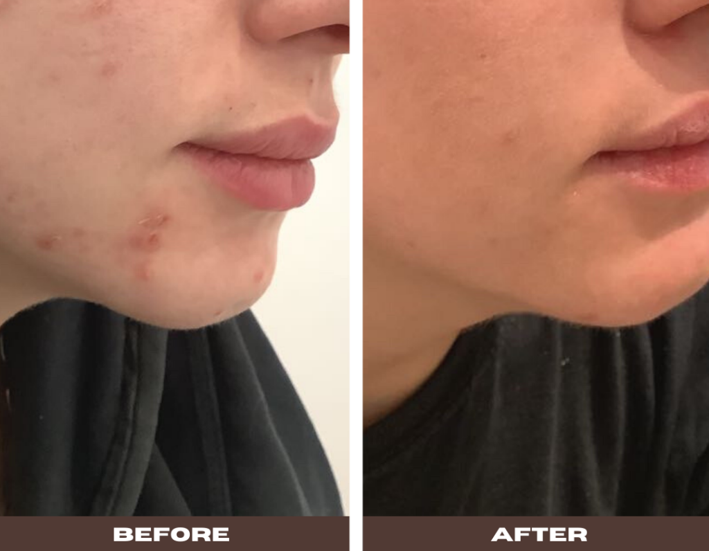 No.23 Skin - Hormonal Acne & Cystic Breakouts: How to Take Back Control