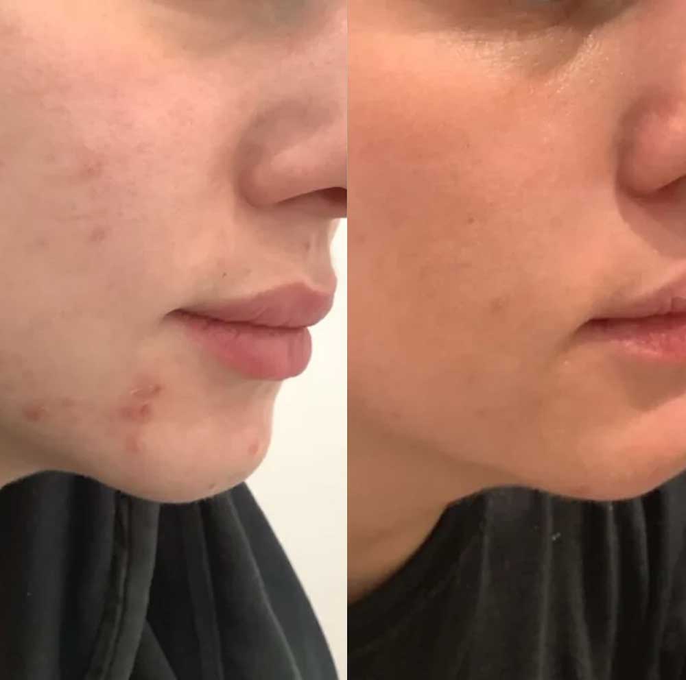 No.23 Kensington Skin Clinc - Breakout Clearing Facial