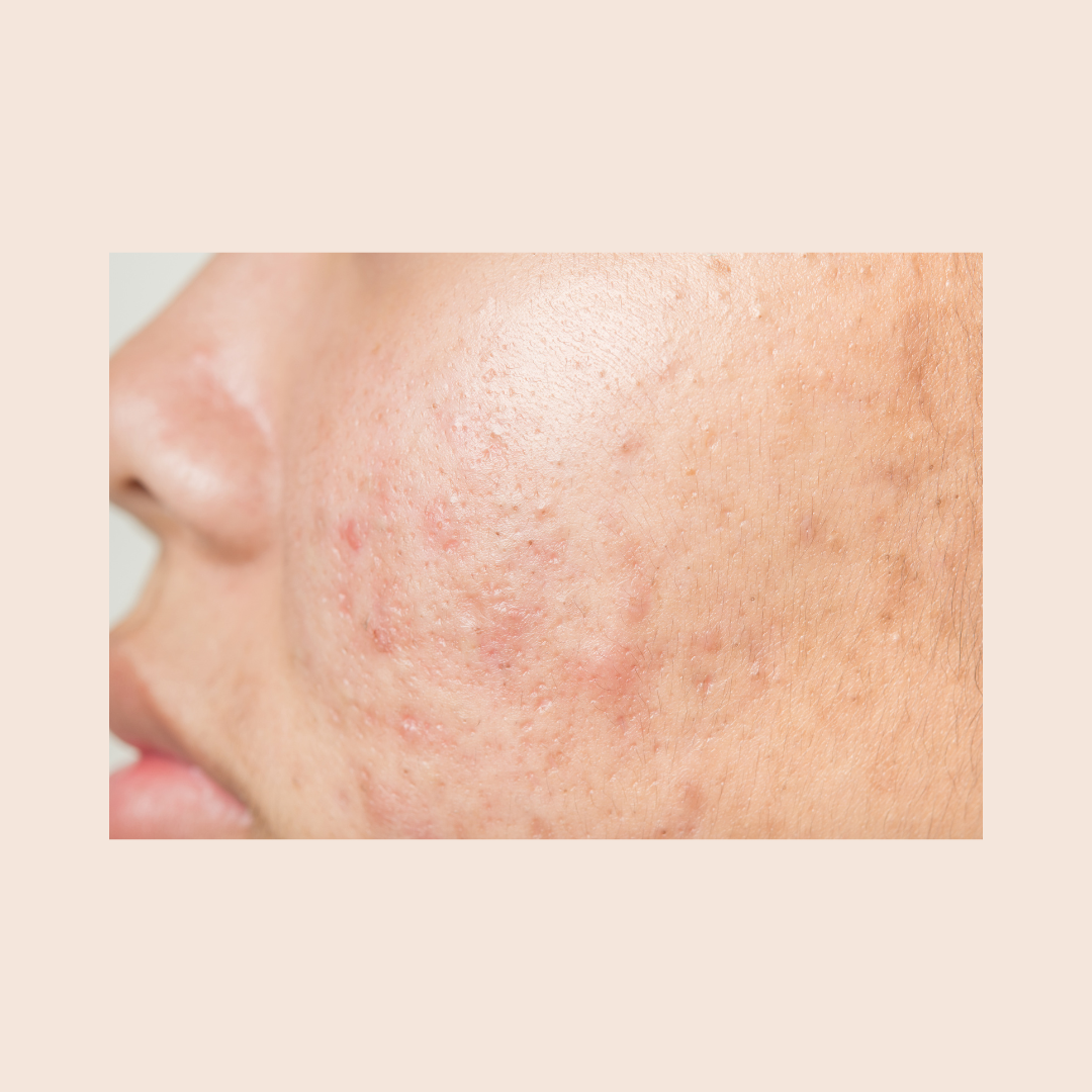 No.23 Kensington Skin Clinc - Advanced Acne Treatment