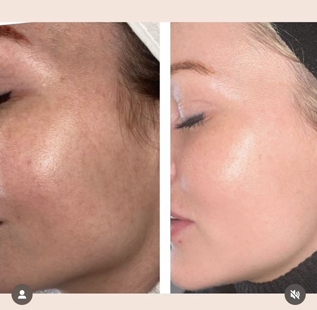 BBL laser before and after