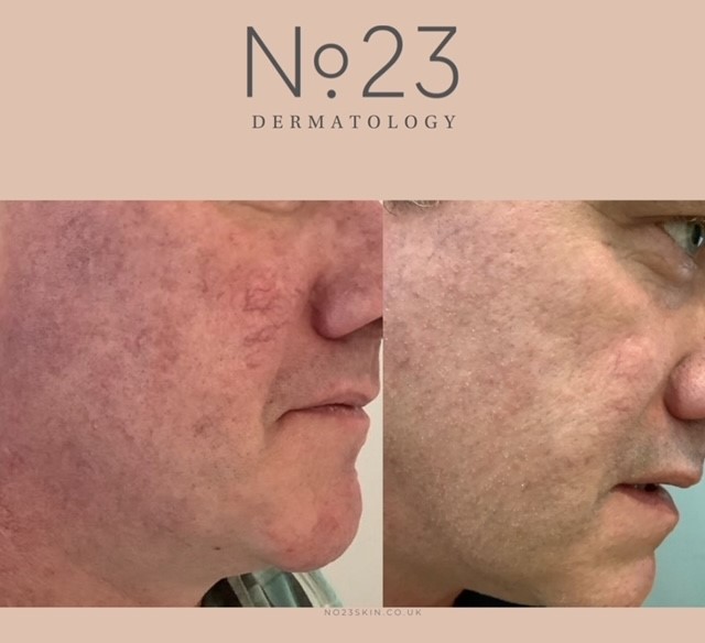rosacea treatment laser