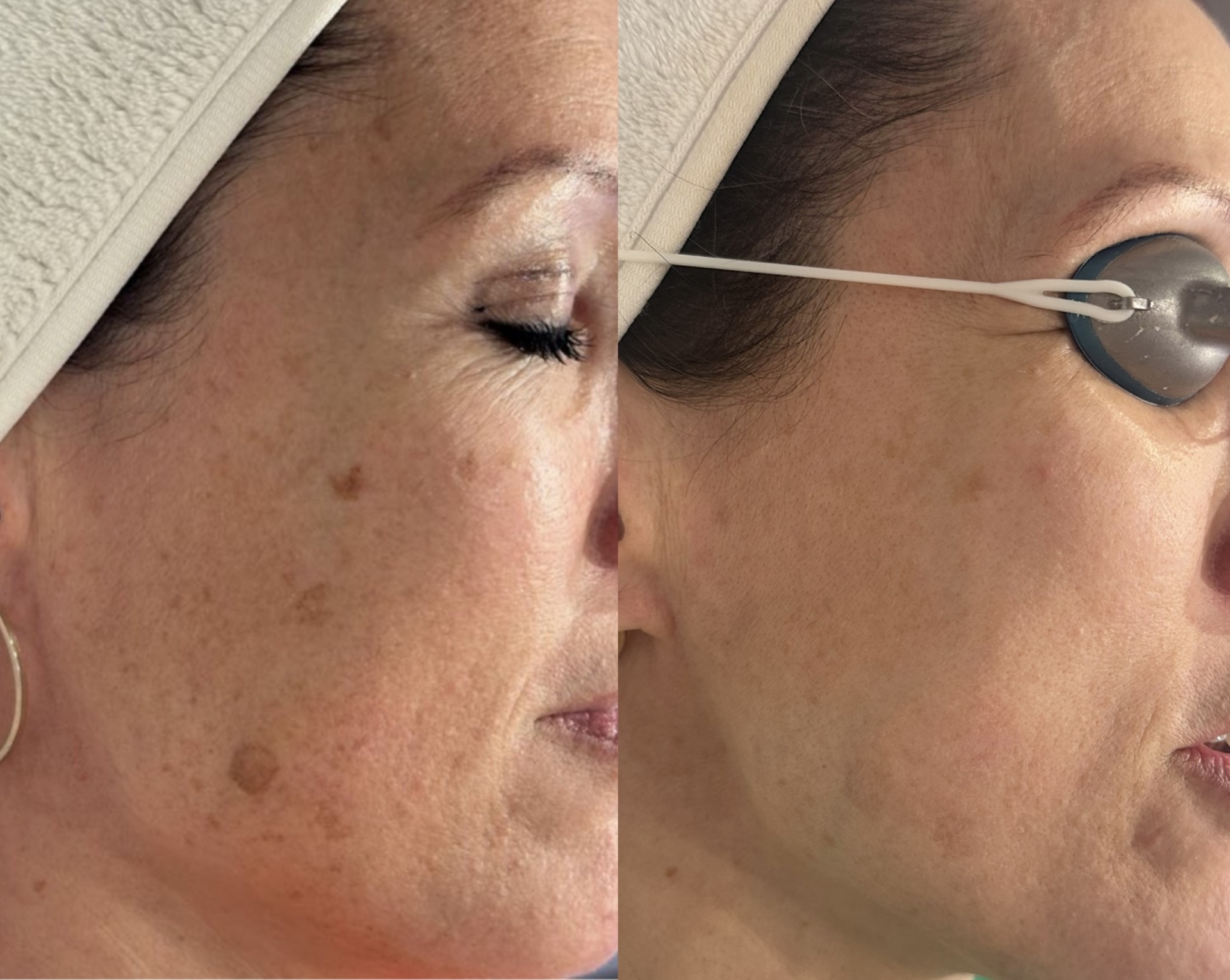 pigmentation treatment