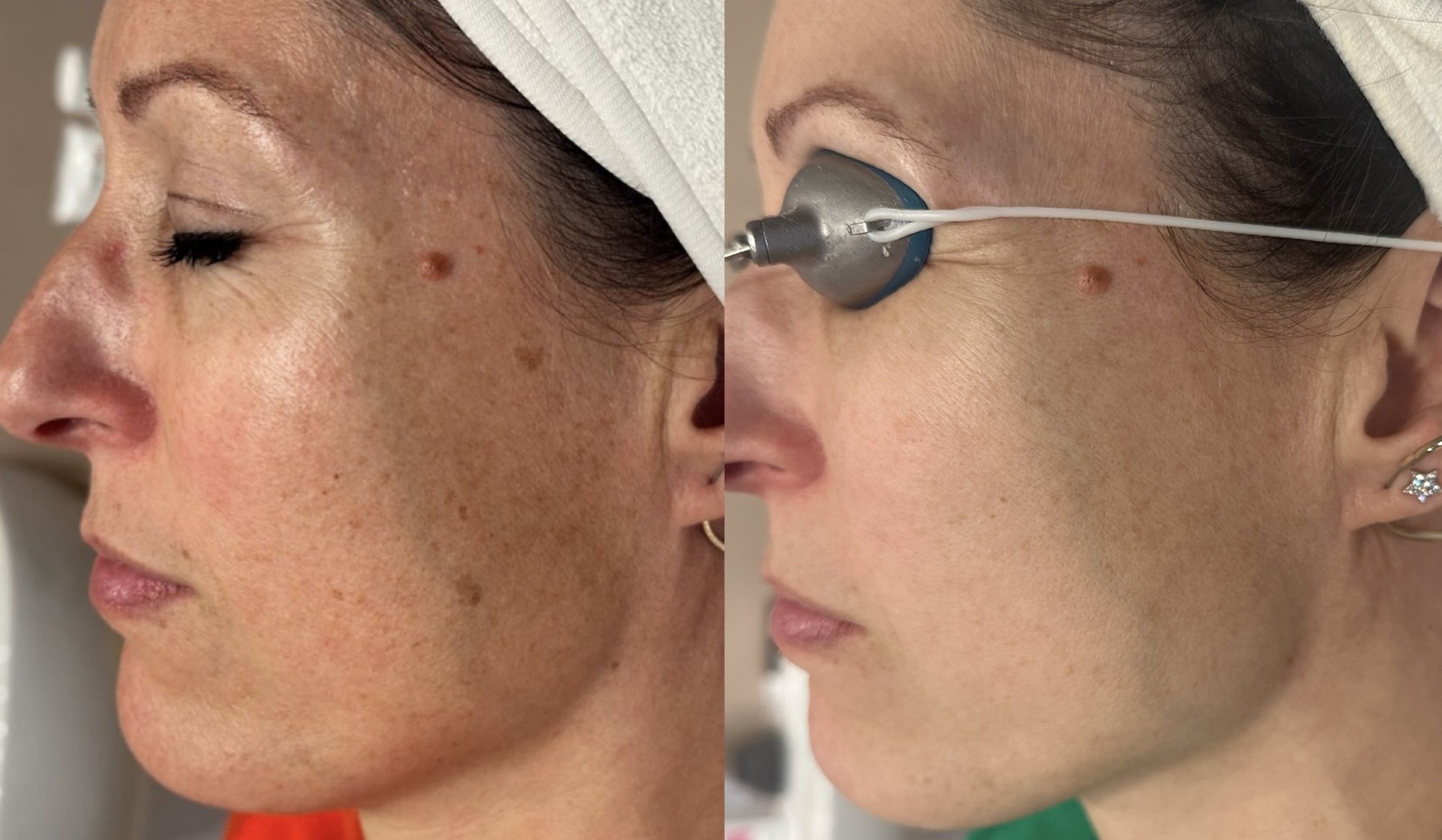 BBL pigmentation treatment