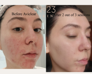 acne laser treatment