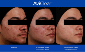 aviclear laser treatment no.23 skin