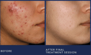 Aviclear laser before and after