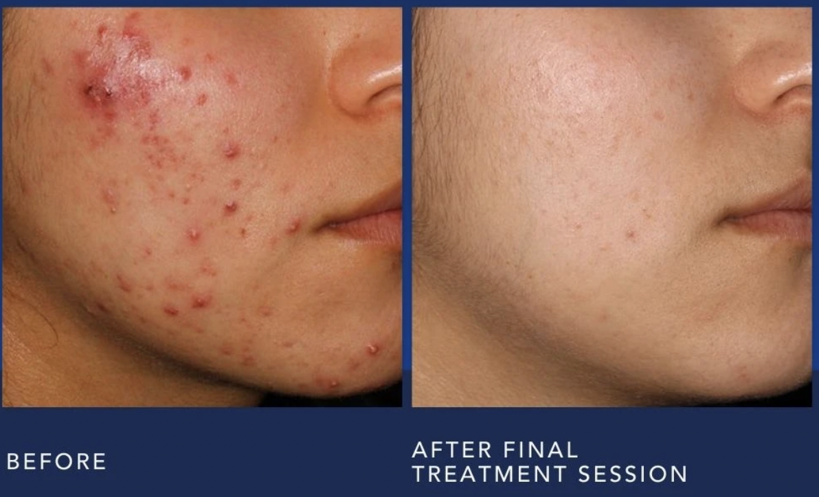 Aviclear laser before and after