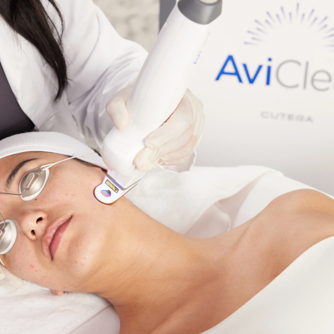 aviclear acne laser treatment
