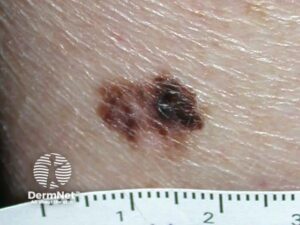 melanoma picture