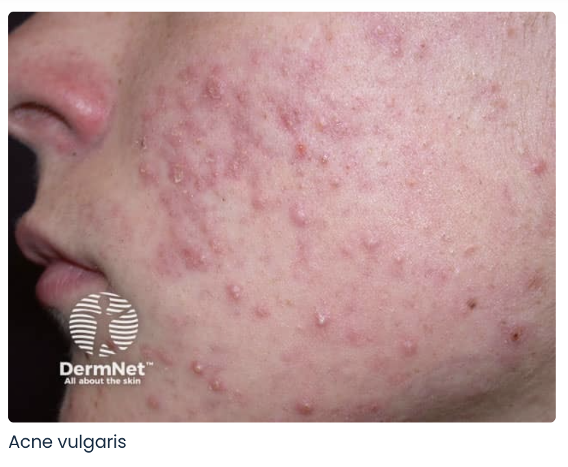 No.23 Skin - Why Your Acne Keeps Coming Back — Even When You Think You’re Doing Everything Right