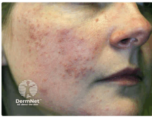 papular rosacea