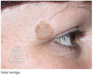 pigmentation sun spot