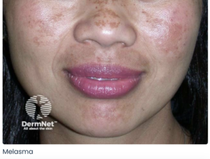 pigmentation melasma