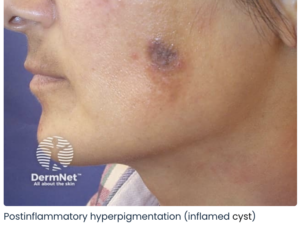 post inflammatory hyperpigmentation treatment