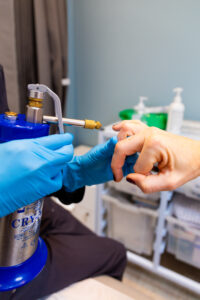 cryotherapy for skin tag